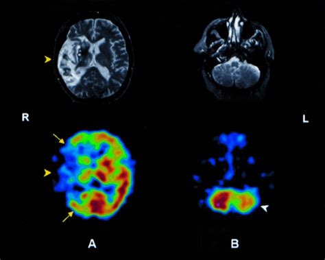 Cerebral Spect Imaging PDF