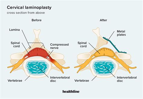 Cervical Laminoplasty 1st Edition Doc