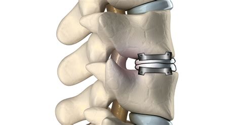 Cervical artificial disc devices