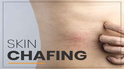 Chafing and irritation: