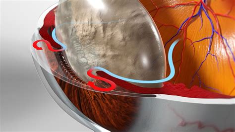 Chloe Amau2: A Comprehensive Guide to Managing Glaucoma