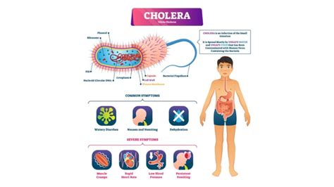 Cholera: