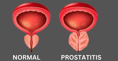 Chronic Prostatitis/Chronic Pelvic Pain Syndrome Kindle Editon