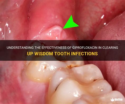 Ciprofloxacin for Tooth Infection: The Ultimate Guide to Treatment and Prevention