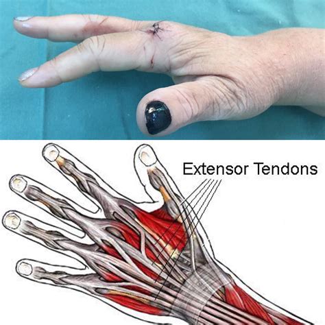 Cirurgia do Tendão do Dedo da Mão: Guia de Valor e Custo