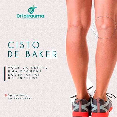 Cisto de Baker: O Guia Definitivo para Diagnóstico e Tratamento