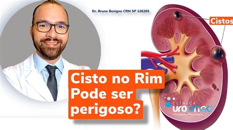 Cisto no Rim: Cuidados, Tratamentos e Prevenção