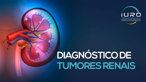 Cisto no Rim: Um Guia Completo para Diagnóstico e Tratamento