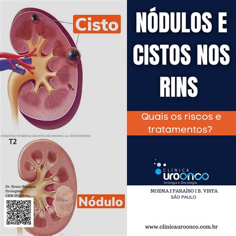 Cisto no Rim: Um Guia Completo para Prevenção, Tratamento e Cura