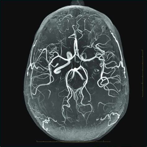 Clinical Magnetic Resonance Angiography Doc