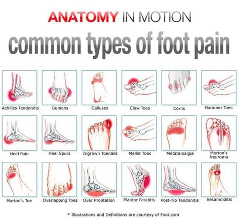 Common Causes of Foot Pain When Walking