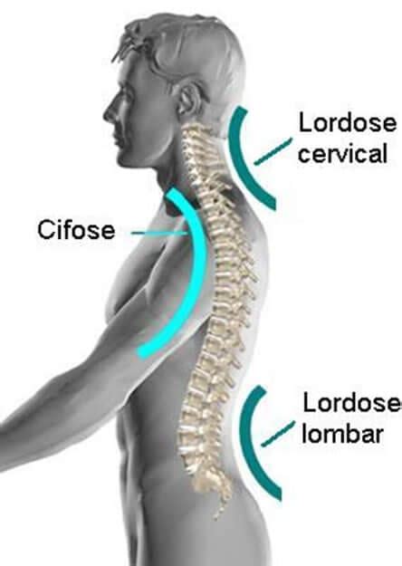 Compreendendo a Lordose Cervical