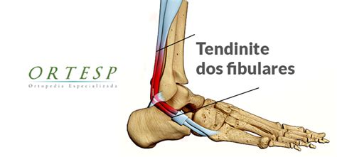 Compreendendo e Gerenciando a Tenossinovite dos Fibulares: Um Guia Definitivo