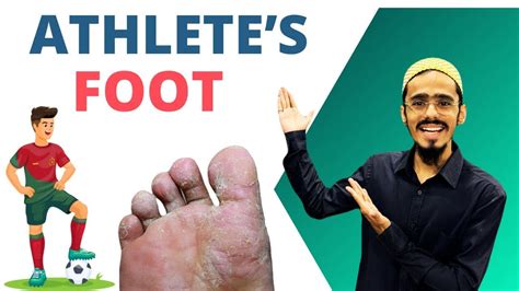 Comprehensive Guide to Athlete's Foot: Causes, Prevention, and Treatment