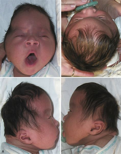 Congenital Abnormalities: