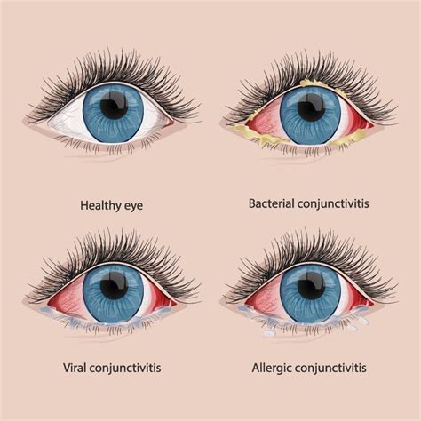 Conjunctivitis: