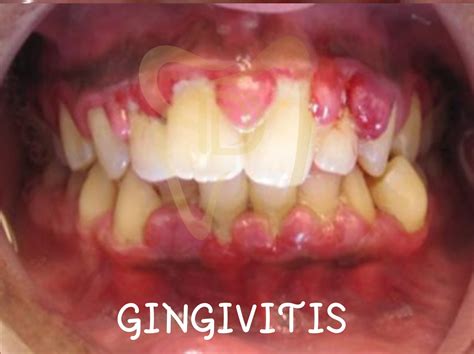 Conquer gingivitis ä¸­æ–‡: A Comprehensive Guide to Restore Gum Health