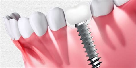 Considering Dental Implants? Here's Why Basal Implants Could Be Your Perfect Smile Solution