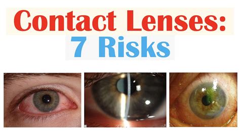 Contact Lens Complications Reader