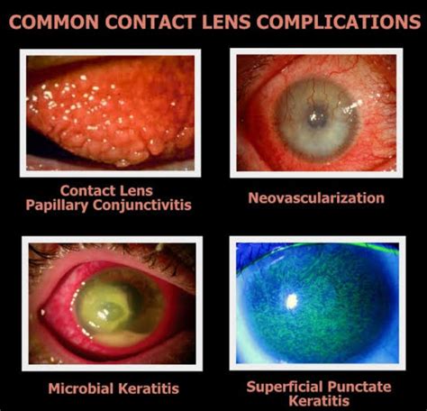 Contact Lens Complications Reader