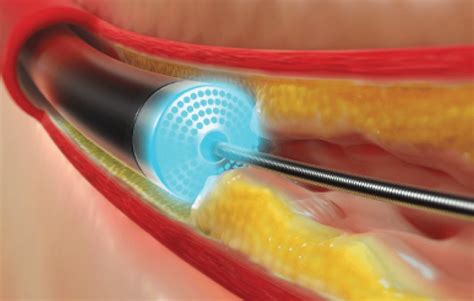 Coronary Excimer Laser Angioplasty An Update PDF