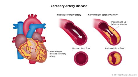 Coronary Heart Disease 2025: The Ultimate Guide VS Causes