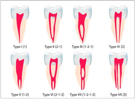 Coverage for root canals: