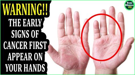 Cracked Fingers: 5 Signs of Cancer You Can't Ignore