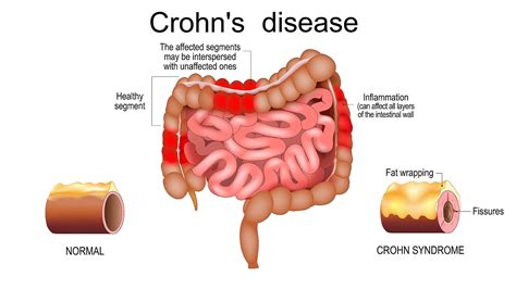 Crohn&am Kindle Editon