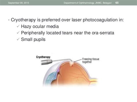 Cryosurgery in Ophthalmology PDF