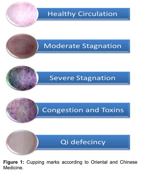 Cupping Bruising Chart