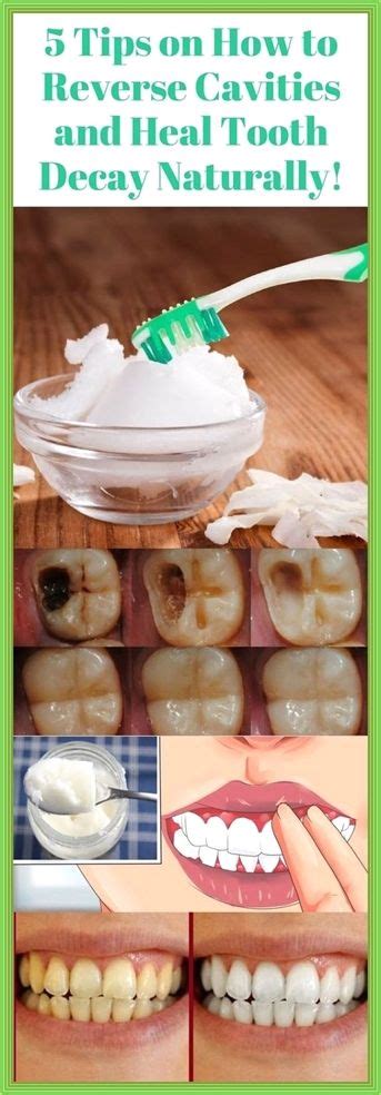 Cure Tooth Decay Remineralize Cavities and Repair Your Teeth Naturally with Good Food Kindle Editon