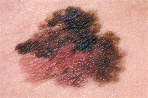 Cutaneous melanoma: