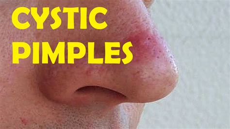 Cystic Pimple on Nose: 5 Painful Facts You Must Know