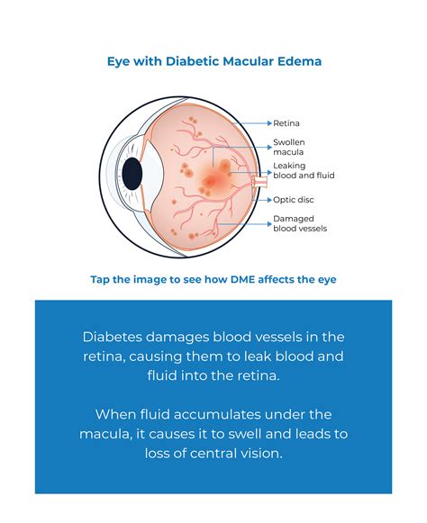 DM240004: A Comprehensive Guide to Understanding and Treating Diabetic Macular Edema