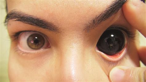 Dark Sclera: