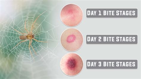 Day 1 Brown Recluse Bite Stages: A Comprehensive Guide