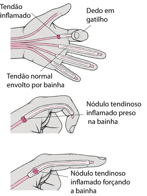 Dedo em Gatilho: Um Guia Completo para Empresas