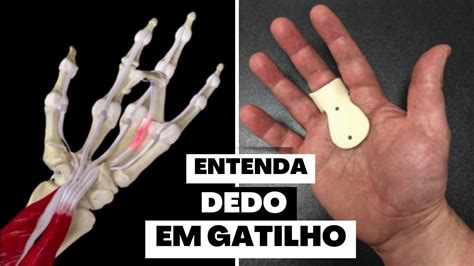 Dedo em Gatilho Cid: O Guia Definitivo para Compreender e Tratar essa Condição Comum