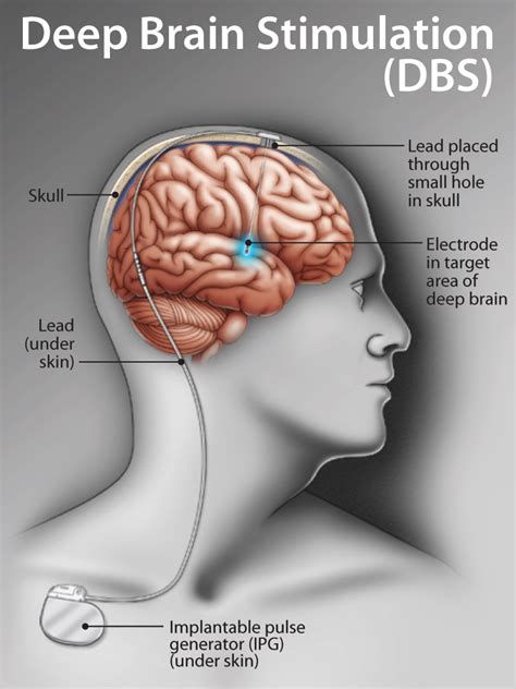 Deep Brain Stimulation (DBS):