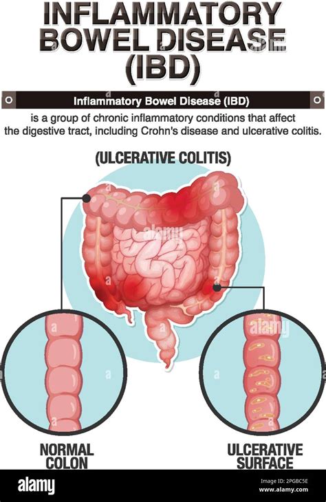 Defining CBS: Clinical Bowel Syndrome and Its Impact