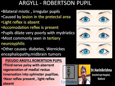 Defining the Argyll Robertson Pupil