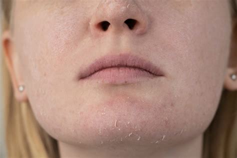 Dehydration: A Common Skin Concern