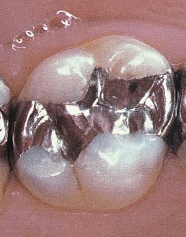 Dental Amalgams: Restoring Oral Health