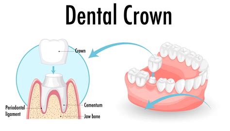 Dental Crown Cost with Insurance: Breaking Down the Numbers