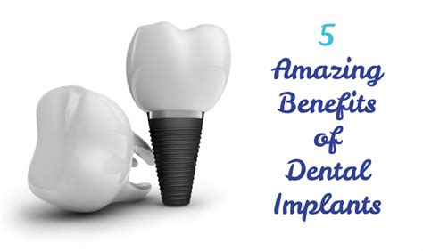 Dental Implants: 7 Amazing Benefits You Can't Afford to Miss