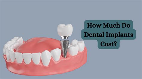 Dental Implants: How Much It Costs