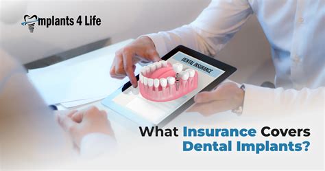 Dental Insurance That Covers Dental Implants: Your Guide to the 10 Most Popular Plans