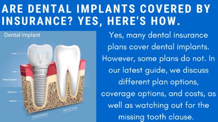 Dental Insurance That Covers Implants: Your Ultimate Guide to Understanding Coverage