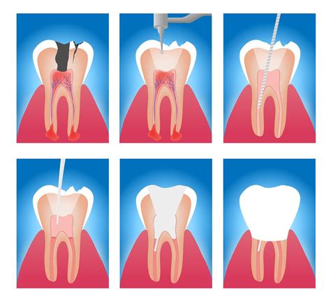 Dental Insurance That Covers Root Canals: Your Ultimate Guide